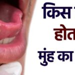 मुंह का कैंसर किस उम्र में होता है? यहां जानिए किन लोगों को Oral Cancer का ज्यादा खतरा है…